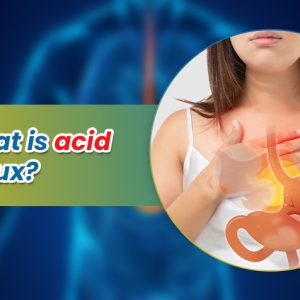 Acid Reflux Disease